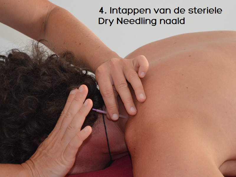 dry-needling-fysiotherapie-zoetermeer-4 dry-needling-fysiotherapie-zoetermeer-4