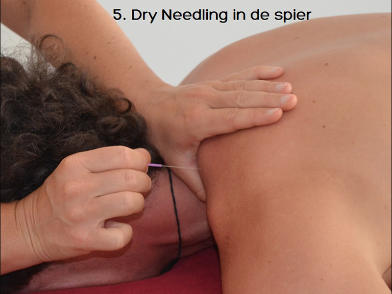 dry-needling-fysiotherapie-zoetermeer-5 dry-needling-fysiotherapie-zoetermeer-5