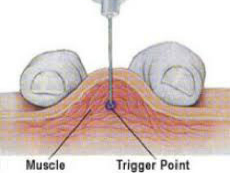 dry-needling-spier-fysiotherapie-zoetermeer dry-needling-spier-fysiotherapie-zoetermeer